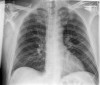 SPORK, NICO - 22.03.1976 - 04.08.2022 - Rö Thorax - 21:31:43 - CHEST